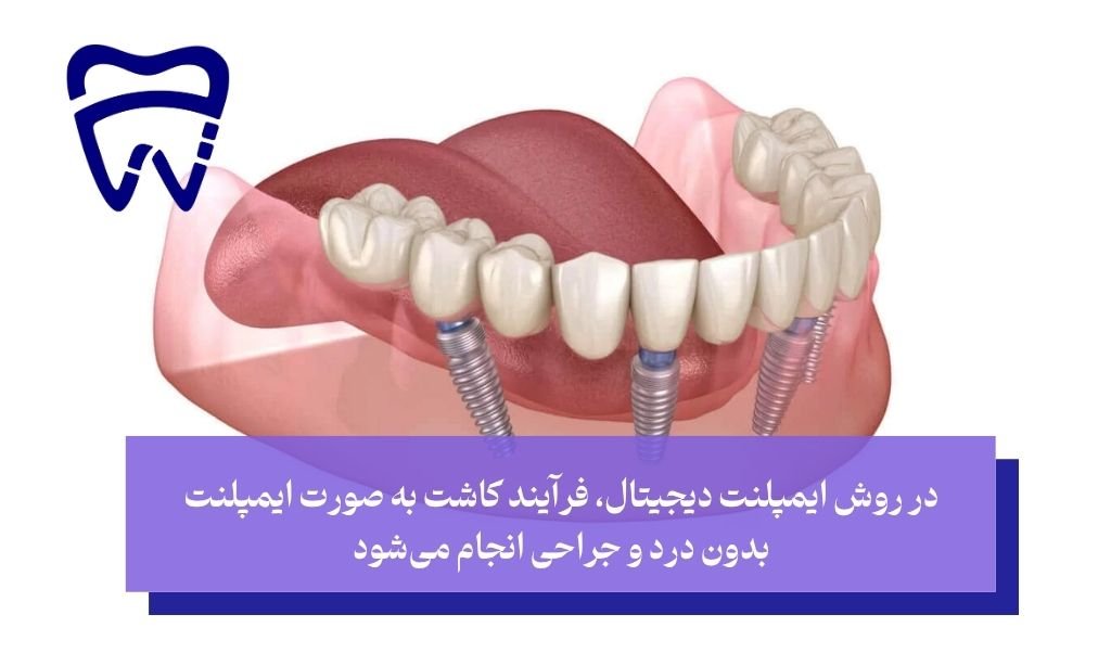 در روش ایمپلنت دیجیتال، فرآیند کاشت به صورت ایمپلنت بدون درد و جراحی انجام می‌شود