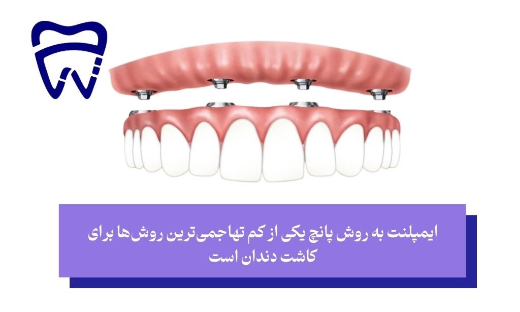 جدیدترین روش ایمپلنت و ایمپلنت به روش پانچ