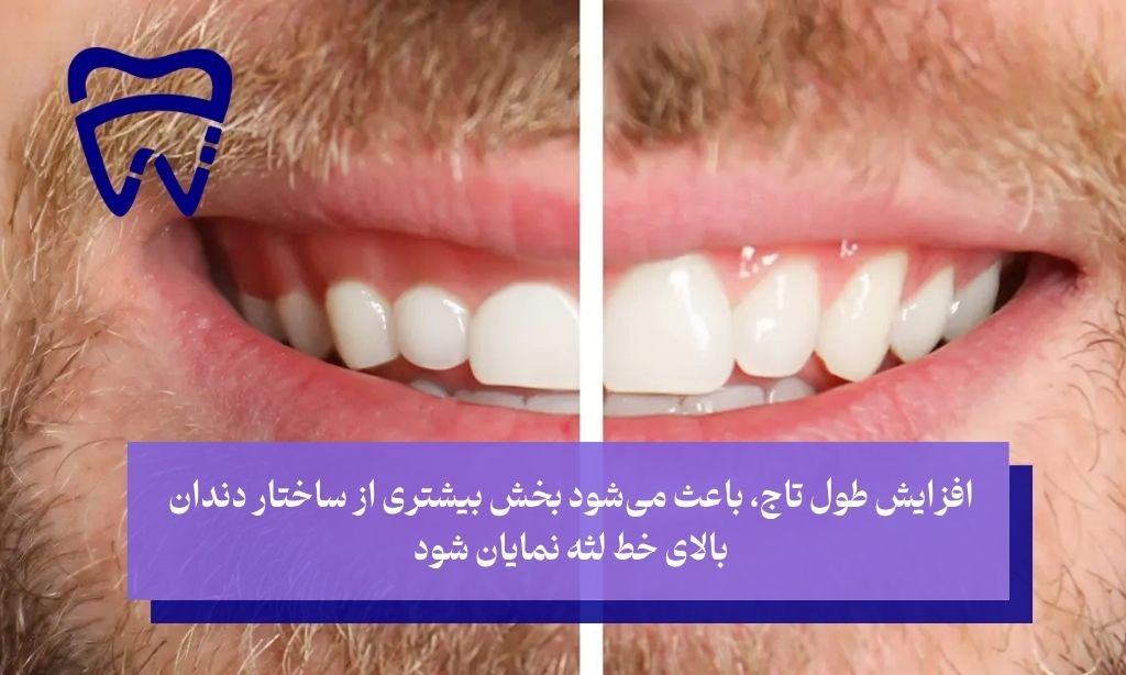 افزایش طول تاج چیست