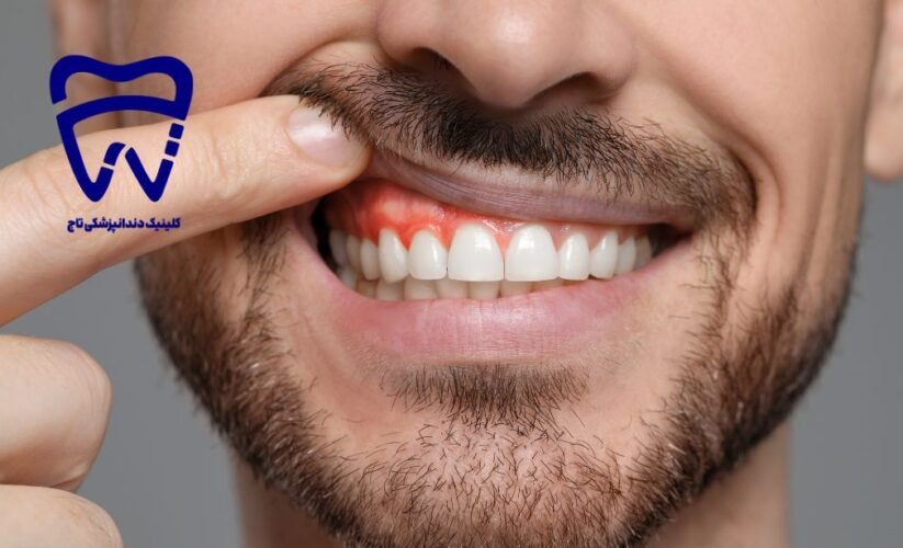 التهاب لثه؛ زنگ خطر برای درمان به موقع