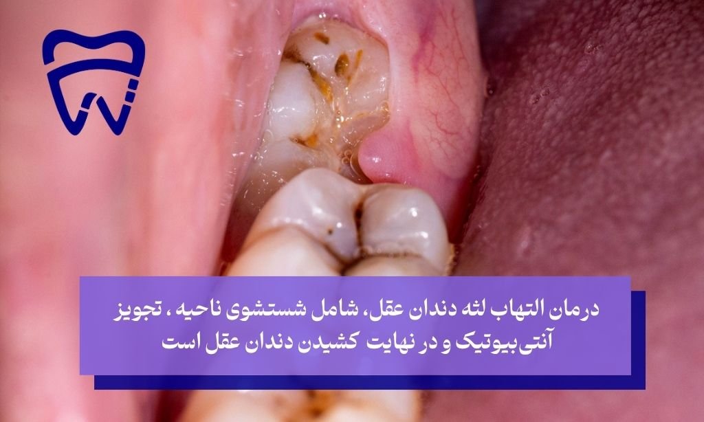 التهاب لثه دندان عقل