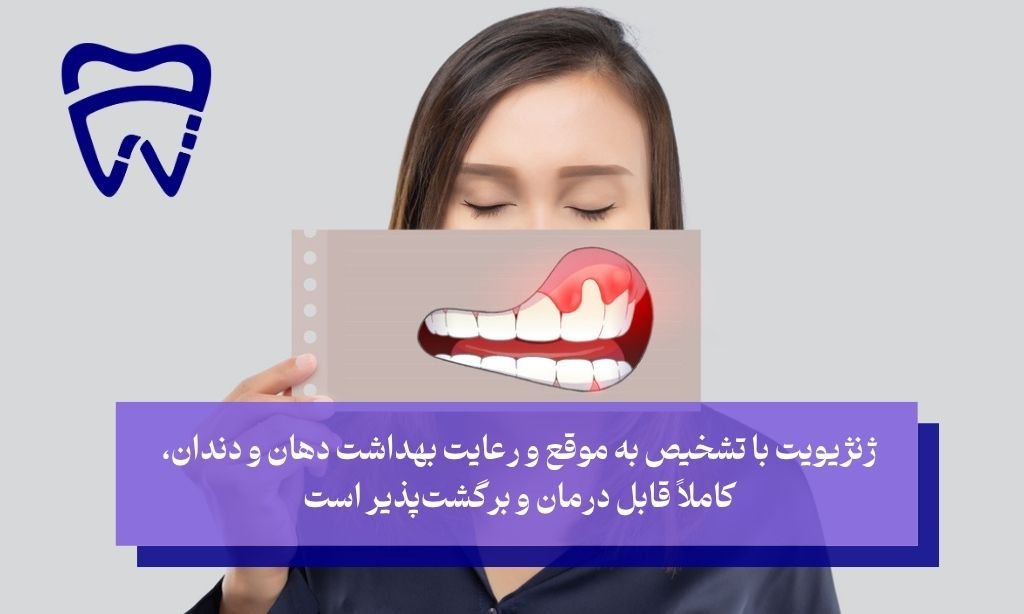 التهاب لثه قابل درمان