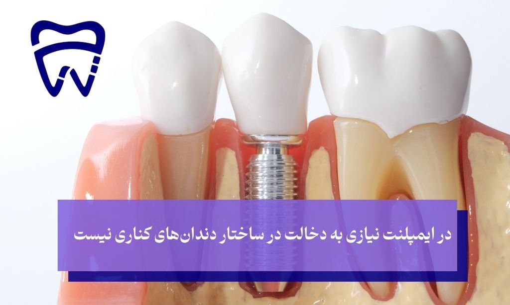 برتری ایمپلنت دندان