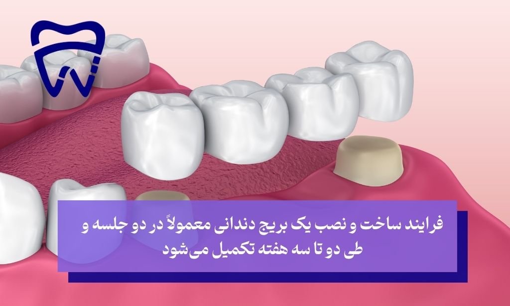 بریج بهتر است یا ایمپلنت از نظر زمان