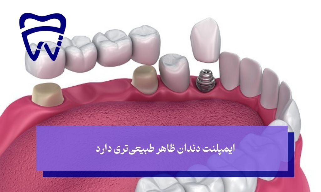 بریج بهتر است یا ایمپلنت از نظر زیبایی
