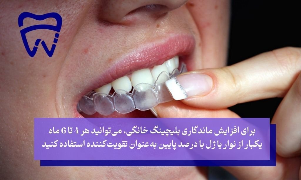 بلیچینگ دندان در خانه چه مدت ماندگاری دارد
