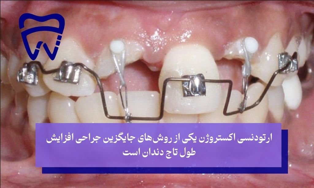 جراحی بلند کردن طول تاج