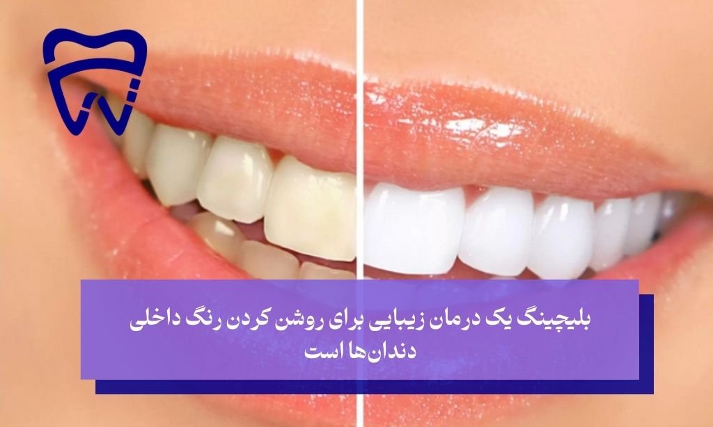 جرم گیری یا بلیچینگ؟ کدام برای شما مناسب است