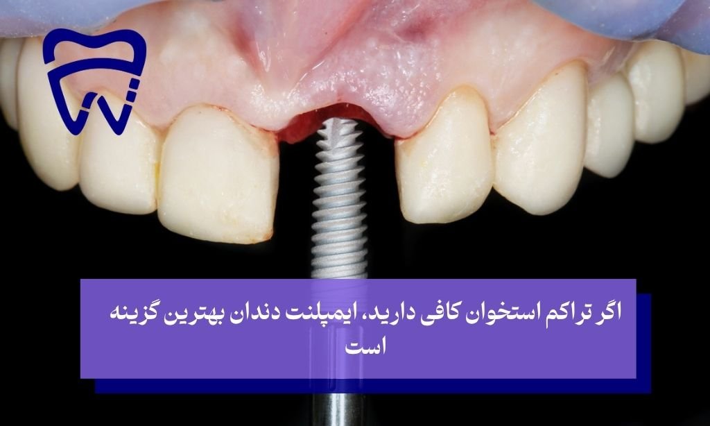 در شرایط خاص بریج بهتر است یا ایمپلنت