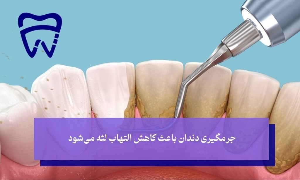 درمان التهاب لثه