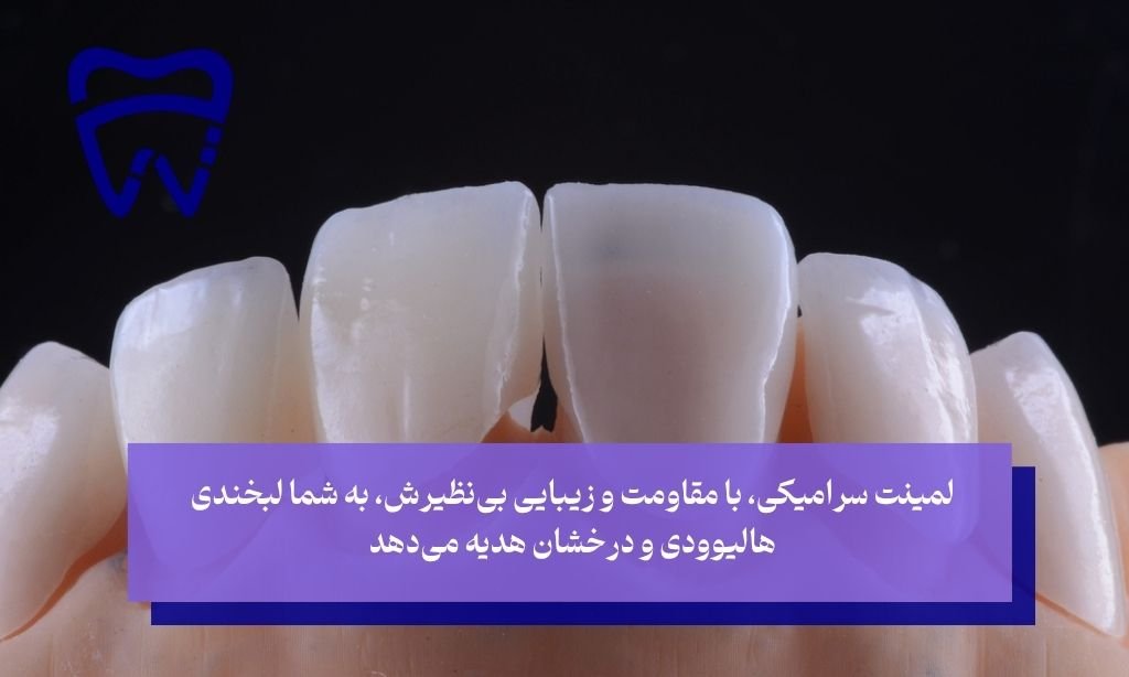 لمینت سرامیکی