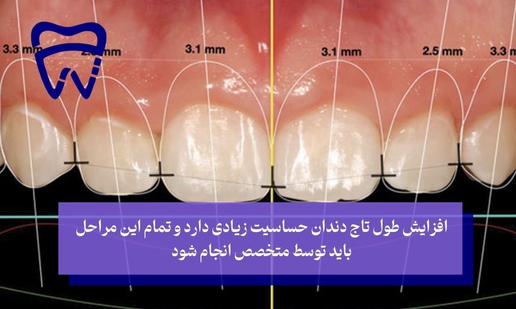 مراحل جراحی افزایش طول تاج دندان